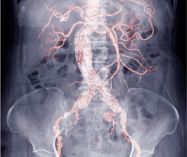 Abdominal Aortic Aneurysm