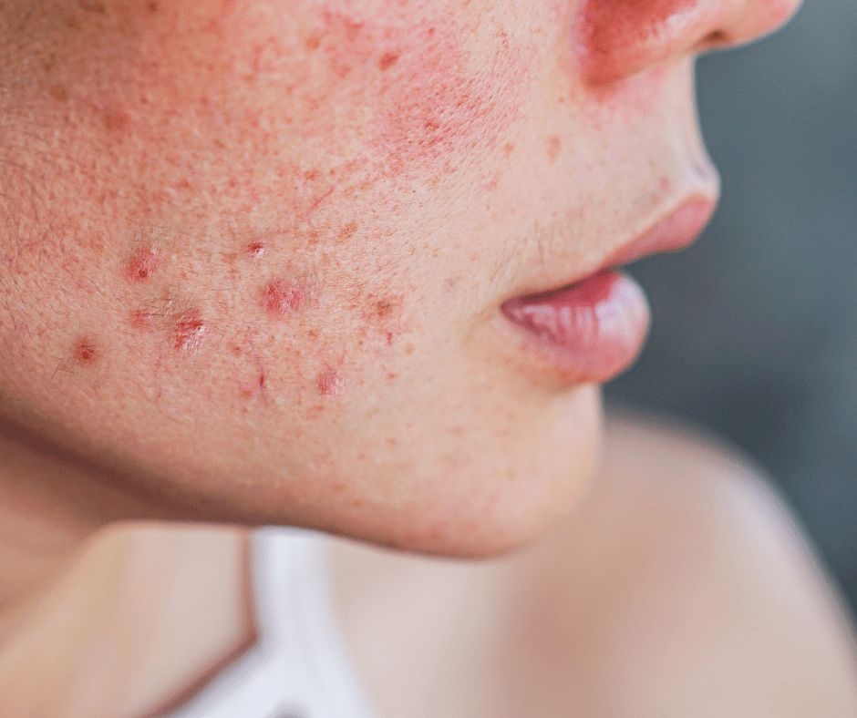 Acne