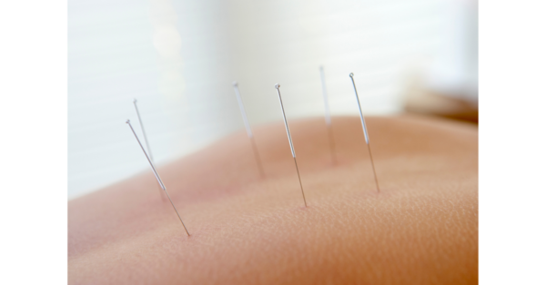 Acupuncture