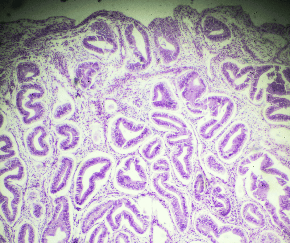 Adenomyosis