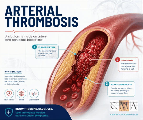 Arterial Thrombosis