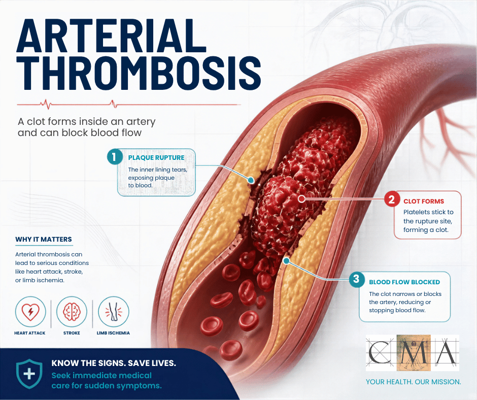 Arterial Thrombosis