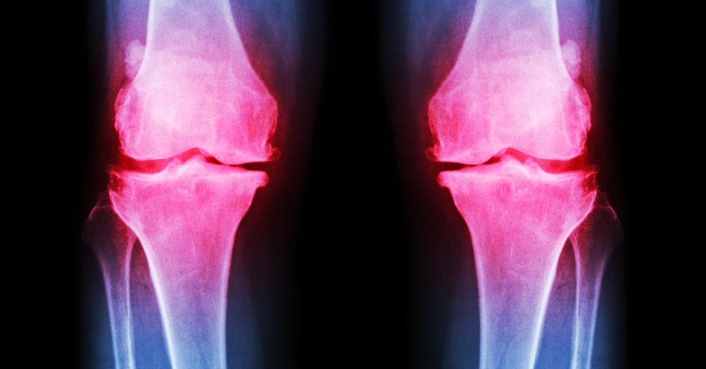 Knee osteoarthritis