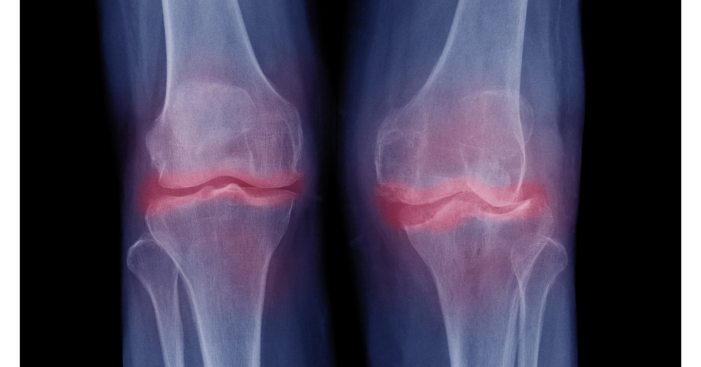 Osteoarthritis