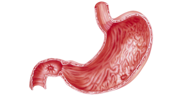 Peptic Ulcer