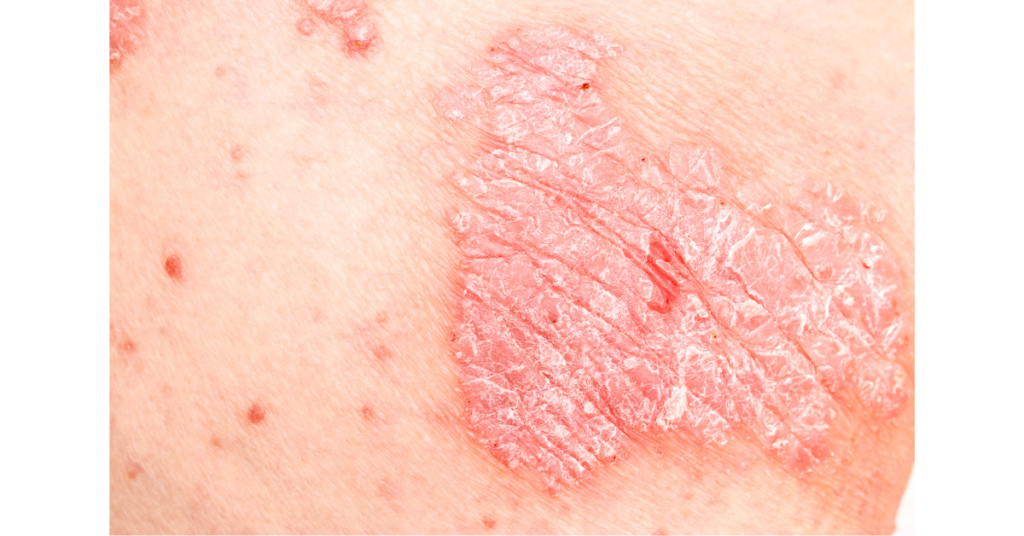 Psoriasis