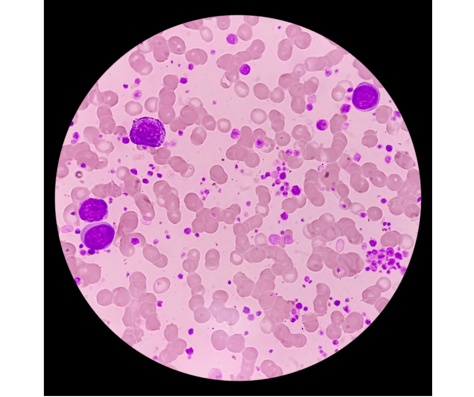 acute myeloid leukaemia