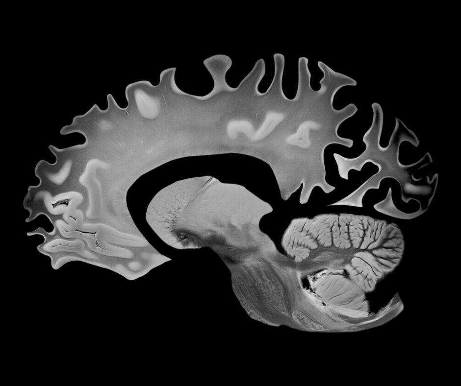 alzheimer's disease