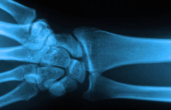 arthritis x-ray feb 12