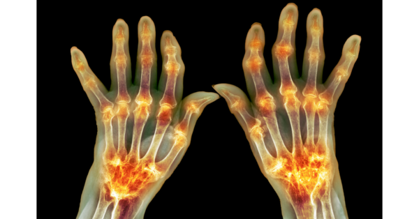 Rheumatoid hands
